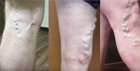 Варикоз: симптомы, причины, признаки, методы лечения и диета Картинка - Варикоз: симптомы, причины, признаки, методы лечения и диета