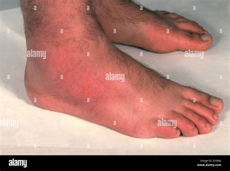 Cellulitis Of Legs Stock Photo Alamy