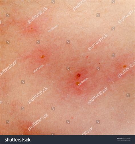 Ill Allergic Rash Dermatitis Eczema Skin Stock Photo 119375080