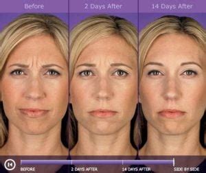 If only the 11 muscles were treated and you keep trying to frown, you can recruit other forehead muscles into frowning. BOTOX® Cosmetic Arlington VA | Facial Wrinkles ...