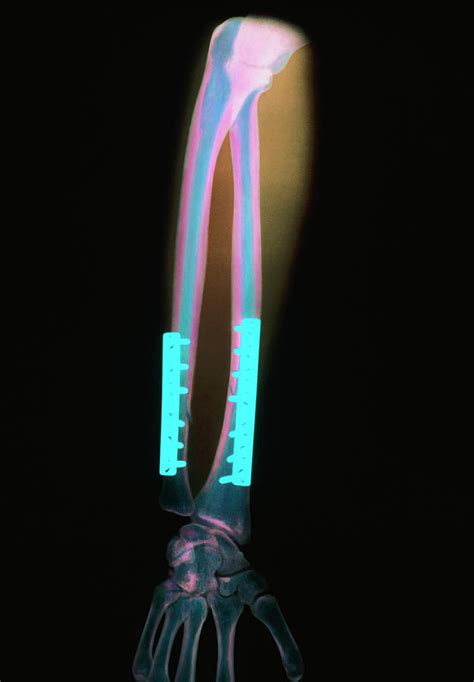 Coloured X Ray Of Arm Fracture Set With Steel Pins Photograph By