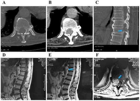 Sacral And Thoracic Chordoma With Pulmonary Metastases A Case Report