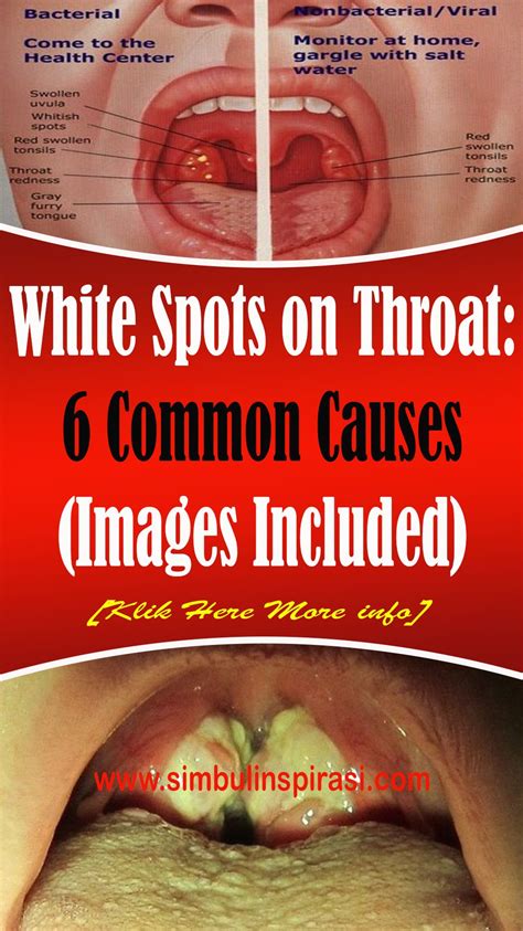 White Spots On The Throat Are Normally An Indication Of Viral Or