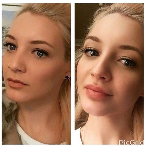 Another Gorgeous Before And After Photo Look At Them Lips Lip