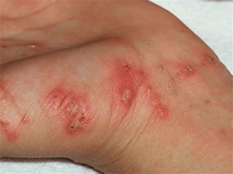 Scrub Typhus deaths rise in Himachal, state govt sends report to health