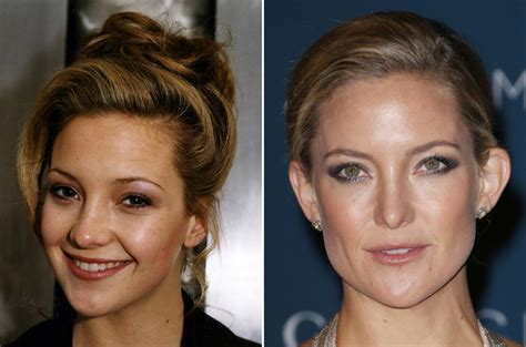 Celebrity Nose Jobs Before And After Irish Mirror Online