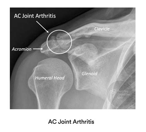 Acromioclavicular Joint Arthritis Sydney Shoulder Unit