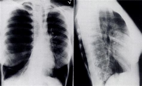 Unilateral Hyperlucent Lung Due To Bullous Disease Chest