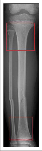 This type of fracture is usually seen in children under four. Tibia and fibula shaft fracture. Fractures extending to ...