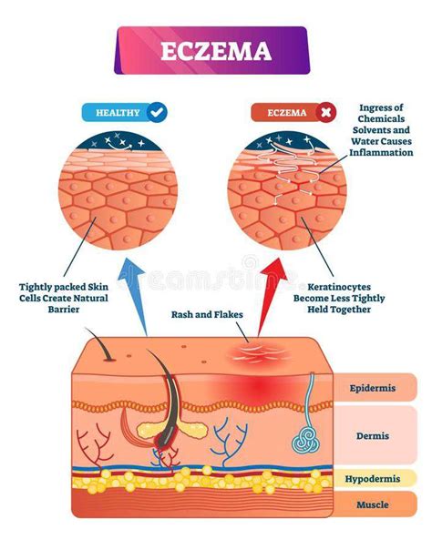 Eczema And Urticaria Allergy Mums