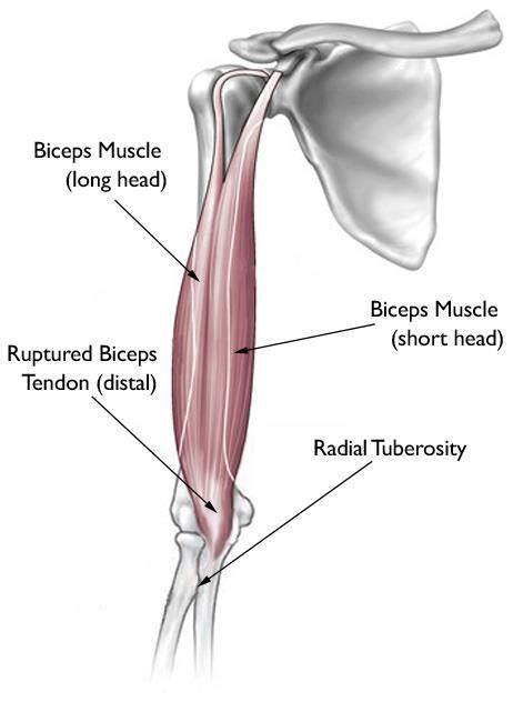 Biceps Tendon Tear At The Elbow Orthoinfo Aaos