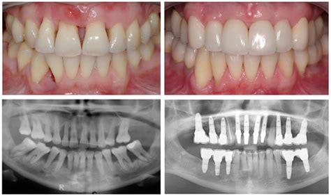 If food particles and bacteria are allowed to accumulate along a cat's gumline, it can form plaque, which, when combined. Rebuilding Bone Loss in Gums - Blog | Advanced Dentistry