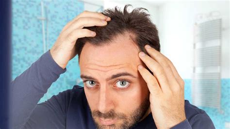 Top 3 Reasons Why Men Lose Their Hair And How To Tackle It