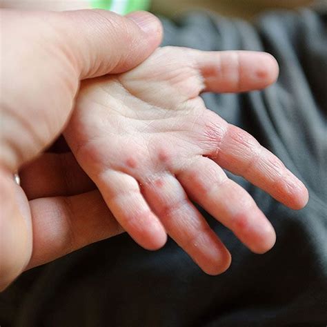 Babies And Skin Allergies Eczema On Hands Psoriasis On Face Eczema