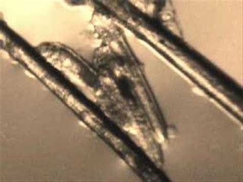 It sometimes causes a condition called demodicosis. Demodex folliculorum - YouTube