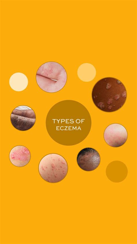7 Types Of Eczema Causes Symptoms Artofit