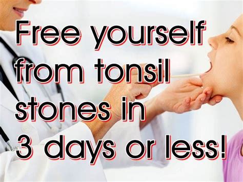 Pin On How To Get Rid Of Tonsil Stones