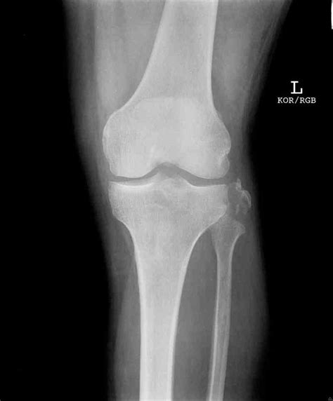 Figure Knee Radiograph Fibular Avulsion Fracture Contributed By