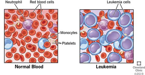 Leukemia Symptoms Signs Causes Types And Treatment