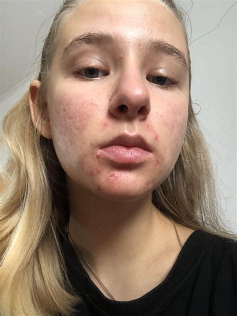 Update On My Skin Please Help Racne