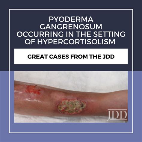 Pyoderma Gangrenosum Occurring In The Setting Of Hypercortisolism