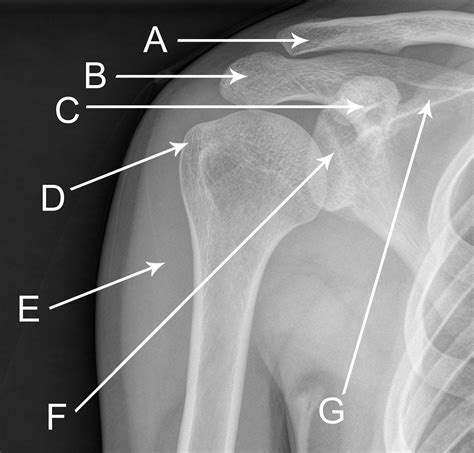 Anteroposterior Radiograph Of The Right Shoulder The Bmj