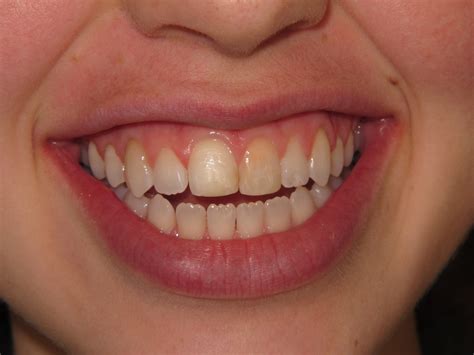 Crowns Smile Gallery Raber Dental Kidron Dentist