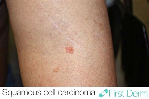 First Derm Squamous Cell Carcinoma
