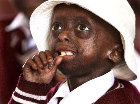 Progeria First Black Child With Rare Aging Disease Photo 8