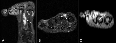 Figure 2 From Magnetic Resonance Imaging Of A Deep Peroneal Intraneural