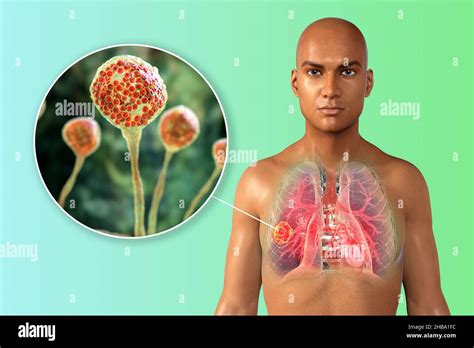 Illustration Of Pulmonary Mucormycosis Or Zygomycosis A Lung Disease