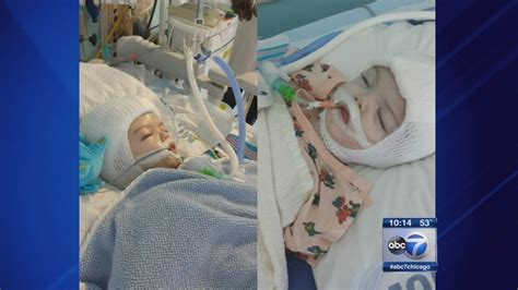 Conjoined Twins From Braidwood Successfully Separated In New York Surgery Abc7 Chicago