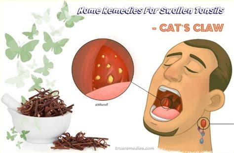 64 Home Remedies For Swollen Tonsils Pain And White Patches