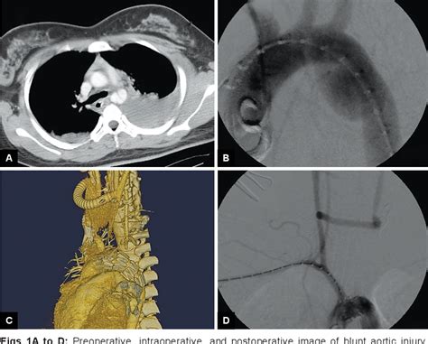 Figure 1 From Orthopedic Operations In Blunt Traumatic Aortic Injury