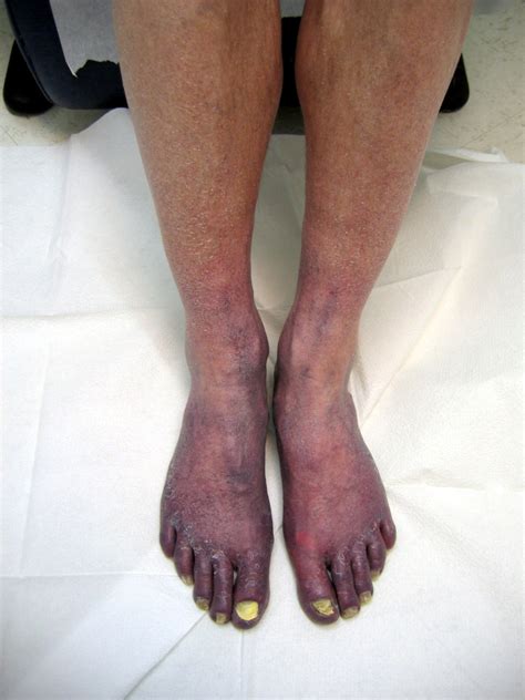 Acrocyanosis A Rare Condition Of The Extremities Almawi Limited