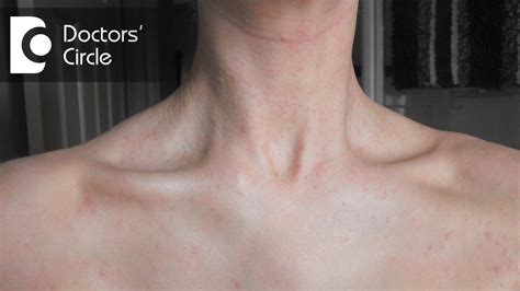 What Causes A Sudden Red Rash Around The Neck In Women Dr Aruna