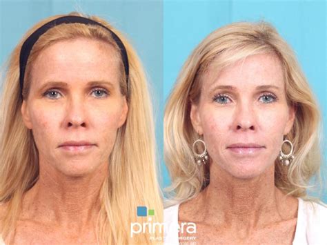 Ultherapy Before And After Photo Gallery Orlando Florida Primera