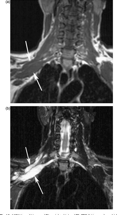 Figure 1 From Mri Of The Brachial Plexus A Pictorial Review