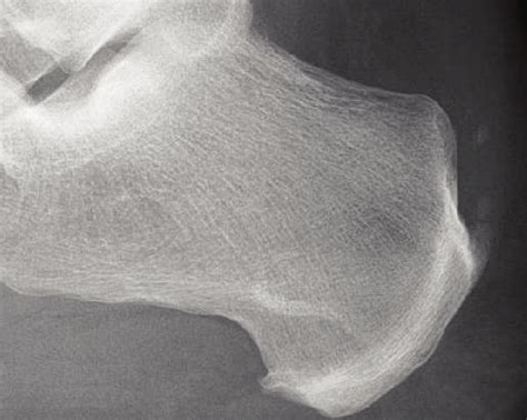 Radiograph Of A Round Calcaneal Spur At The Achilles Tendon Insertion