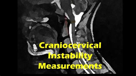 Craniocervical Instability Understanding Cci Measurements