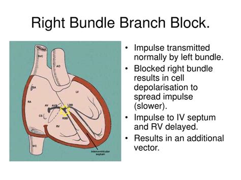 Medial Bundle Branch Block