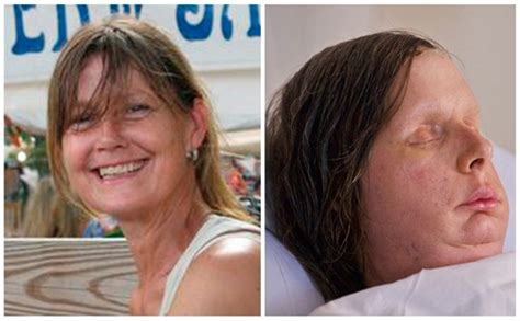 Chimp Attack Womans Body Rejecting Face Transplant