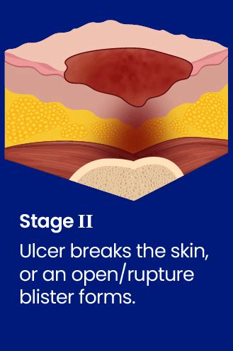 What Are The Stages Of Bedsores Are They Preventable Treatable