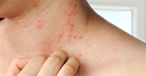 Living With Dermatitis Types Causes And Treatment Advanced Skin