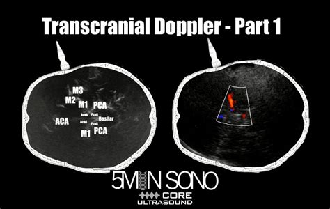 5 Minute Sono Transcranial Doppler Part 1 Core Ultrasound