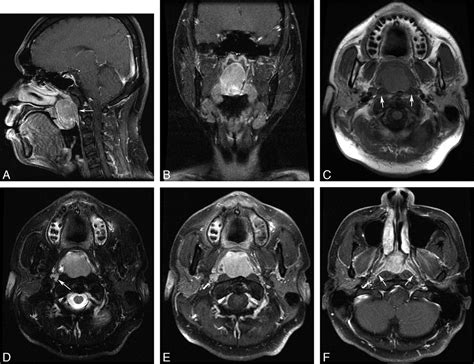 Leiomyosarcoma In The Nasopharynx Mr Imaging Findings American
