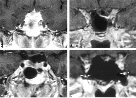 MR Imaging Of The Trigeminal Ganglion Nerve And The Perineural