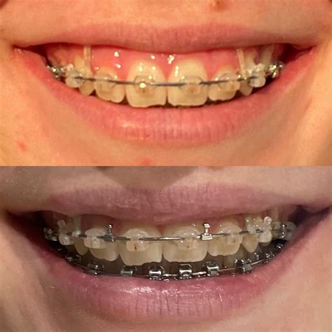8 Month Progress With Tads To Fix My Gummy Smile Rbraces