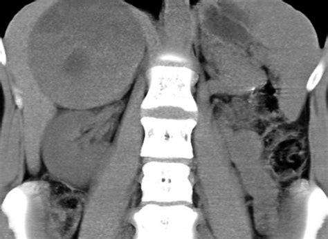 Adrenal Mass Imaging With Multidetector Ct Pathologic Conditions