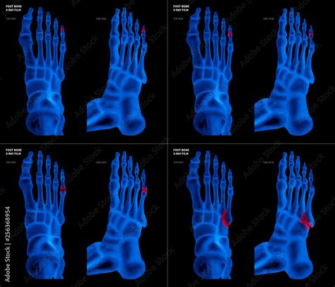 X Ray Of Collection Arthritis Little Toe Joint Foot Bone Red Highlights